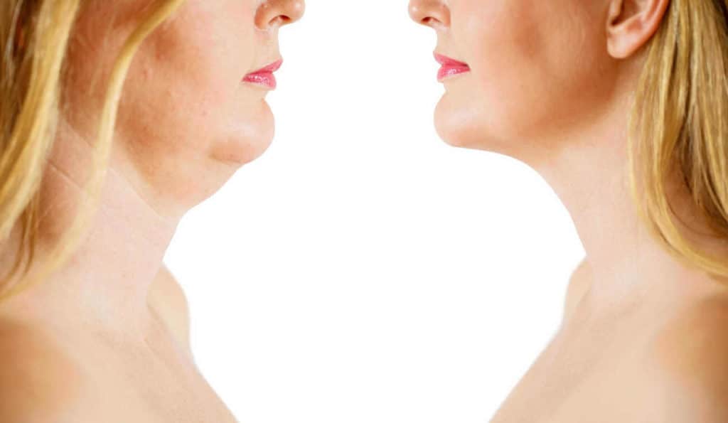 Double Chin treatment Eastbourne before and after results