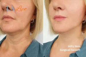 hi-fu for wrinkles Eastbourne before and after results