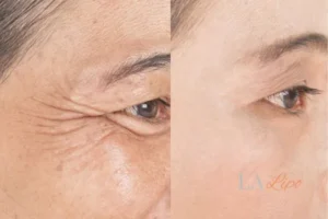 Before and after results of woman - HI-fu wrinkles reduction treatment Eastbourne
