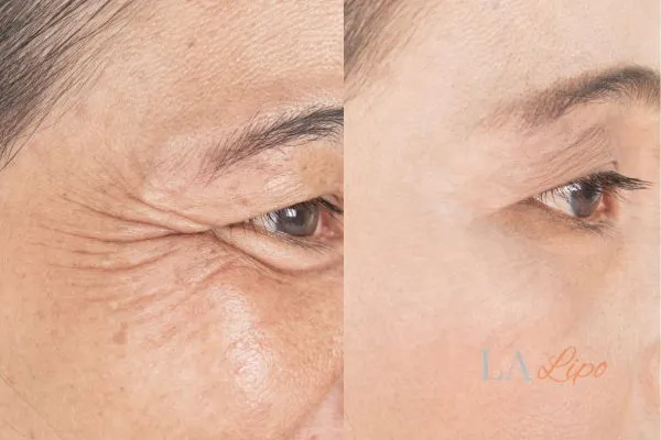 Before and after results of woman - HI-fu wrinkles reduction treatment Eastbourne