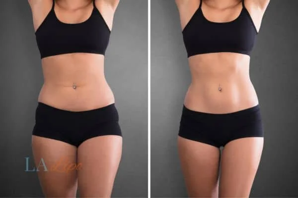 before and after results of non-surgical treatment to help a woman's body image and mental health Eastbourne