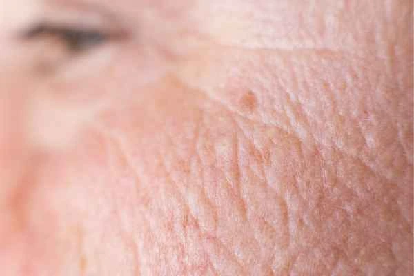 close up picture of a woman's face showing an age spot Eastbourne