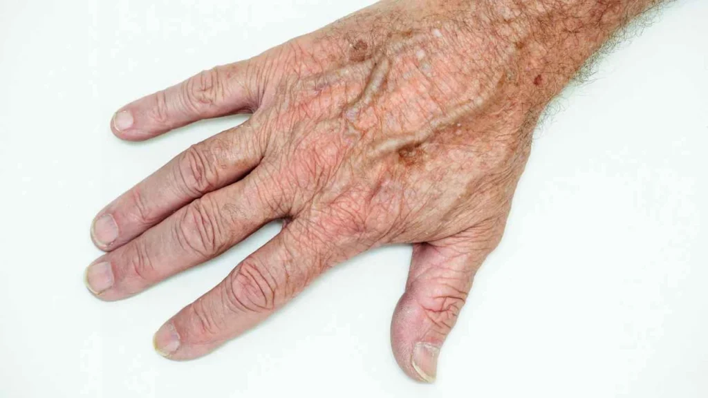 Male hand showing age spot Eastbourne