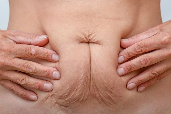 Should I Combine Diastasis Recti Treatment with Body Contouring for Better Results Eastbourne?