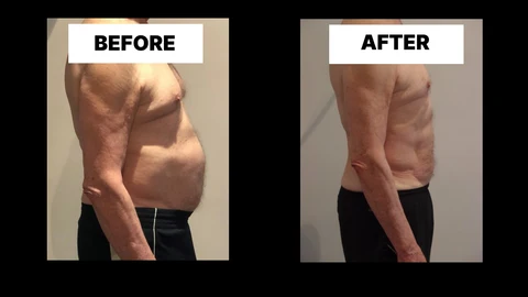 What Symptoms Can Diastasis Recti Cause in Men? Weak Core, Back Pain and Poor Posture Eastbourne